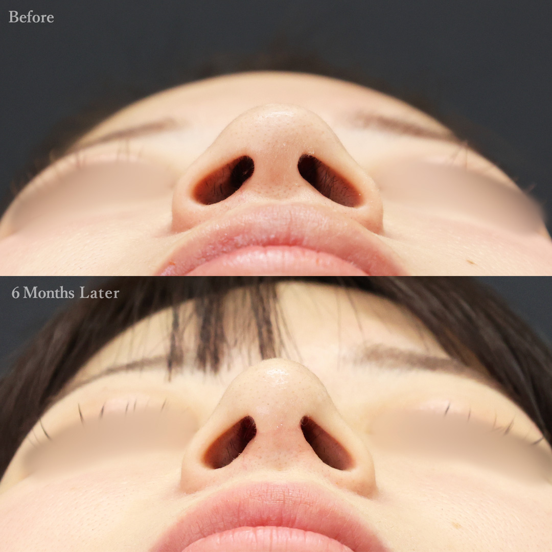 TAC式 ツヤ肌コラーゲンリフト®/顔の脂肪吸引/鼻尖形成・鼻尖縮小の症例写真 施術前後