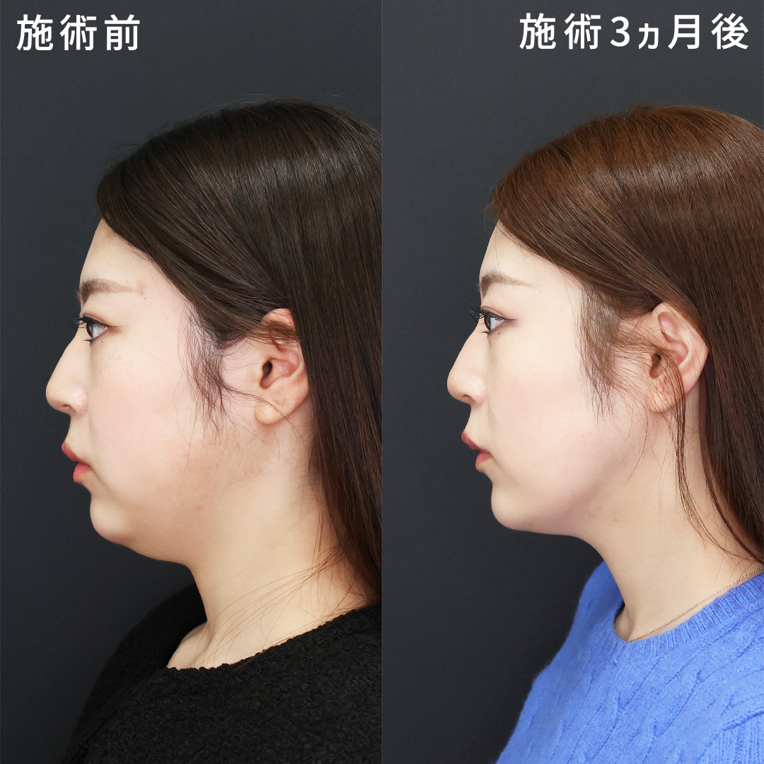 顔の美容外科手術 顔の美容外科手術 ZX-CLINIC【公式】｜大阪梅田・北新地からすぐ
