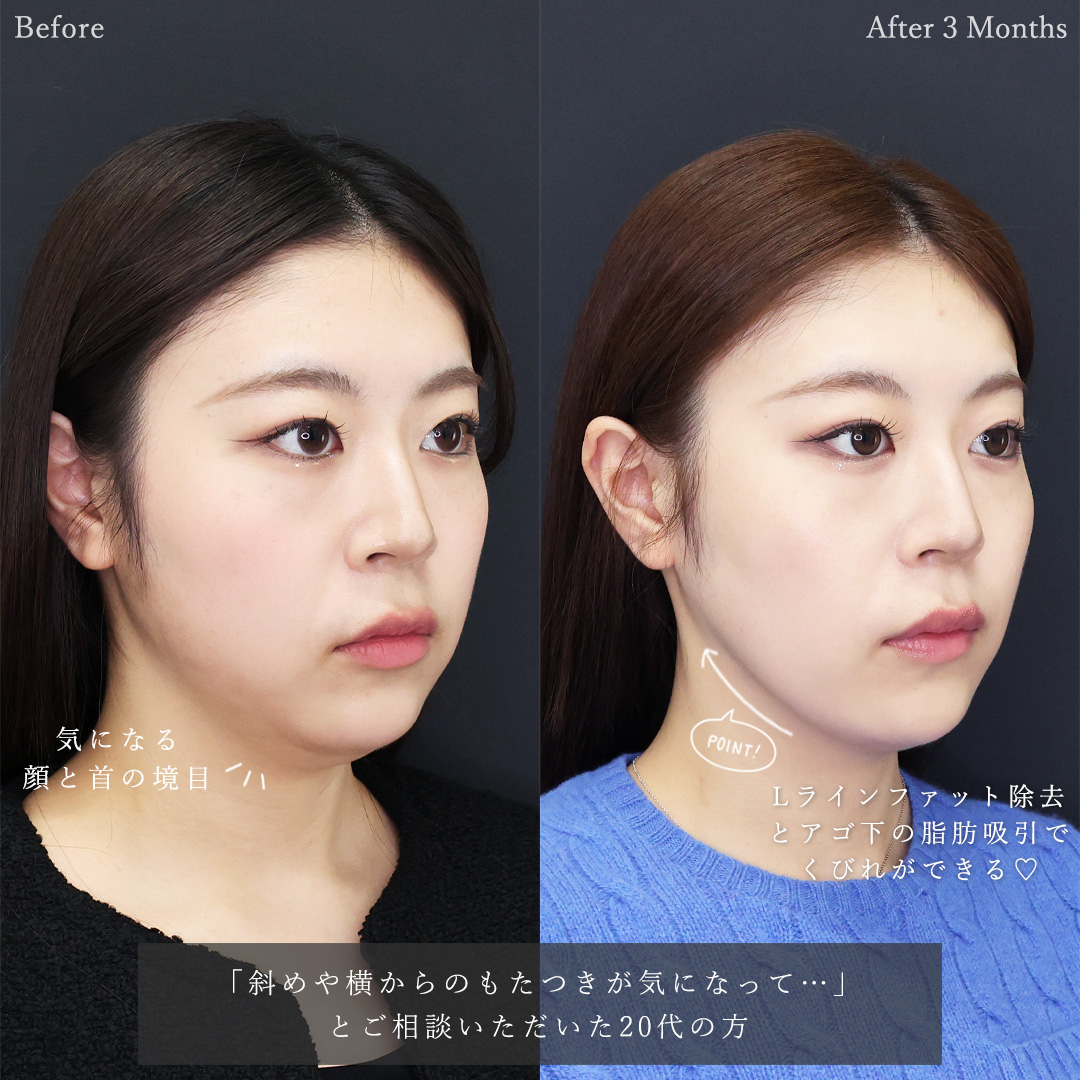 TAC式 ツヤ肌コラーゲンリフト®/Lラインファット除去（エラ下脂肪除去）/顔の脂肪吸引の症例写真 施術前後 