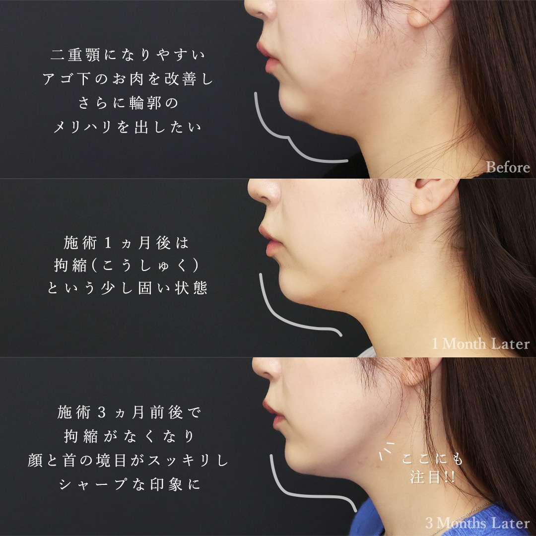 TAC式 ツヤ肌コラーゲンリフト®/Lラインファット除去（エラ下脂肪除去）/顔の脂肪吸引の症例写真 施術前後 