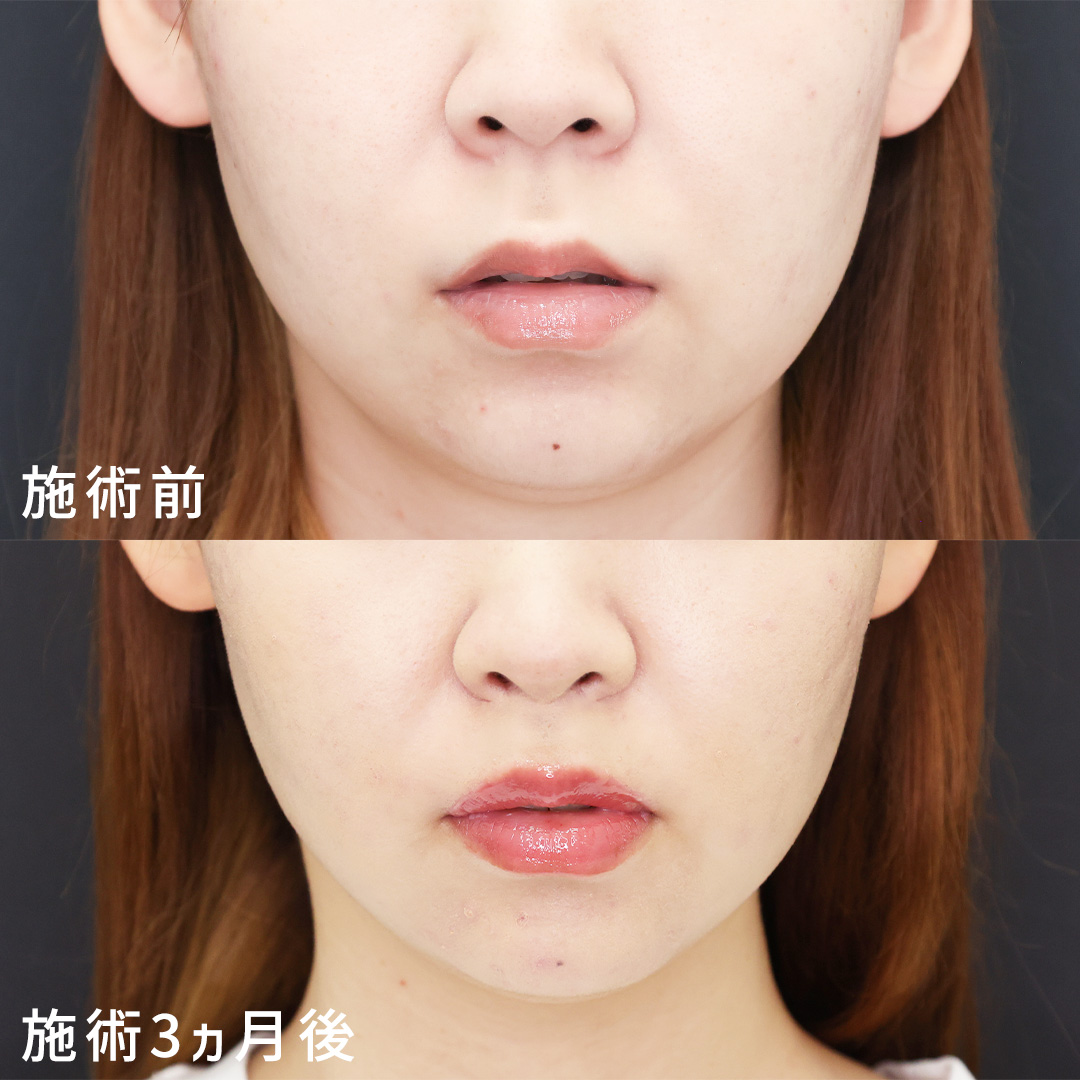 人中短縮術＋外側人中短縮術で気になる口元をアップデート