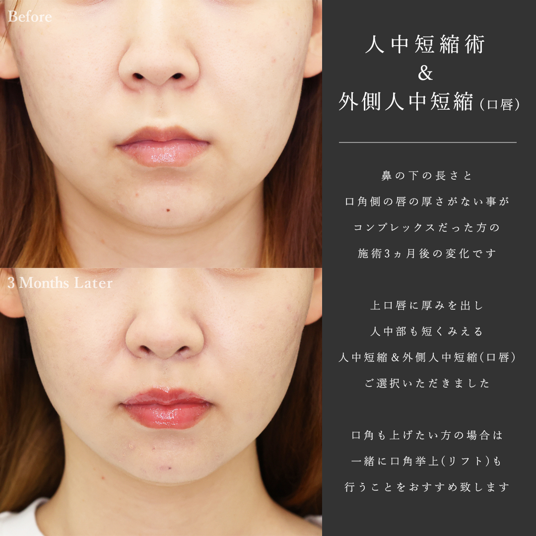 人中短縮術(リップリフト)・外側人中短縮術の症例写真 施術前後 