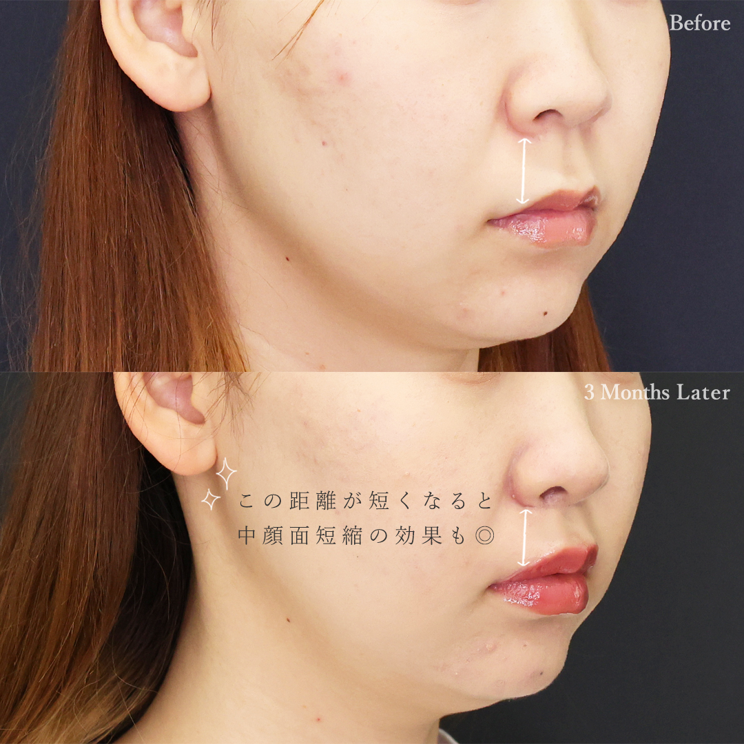 人中短縮術(リップリフト)・外側人中短縮術の症例写真 施術前後 