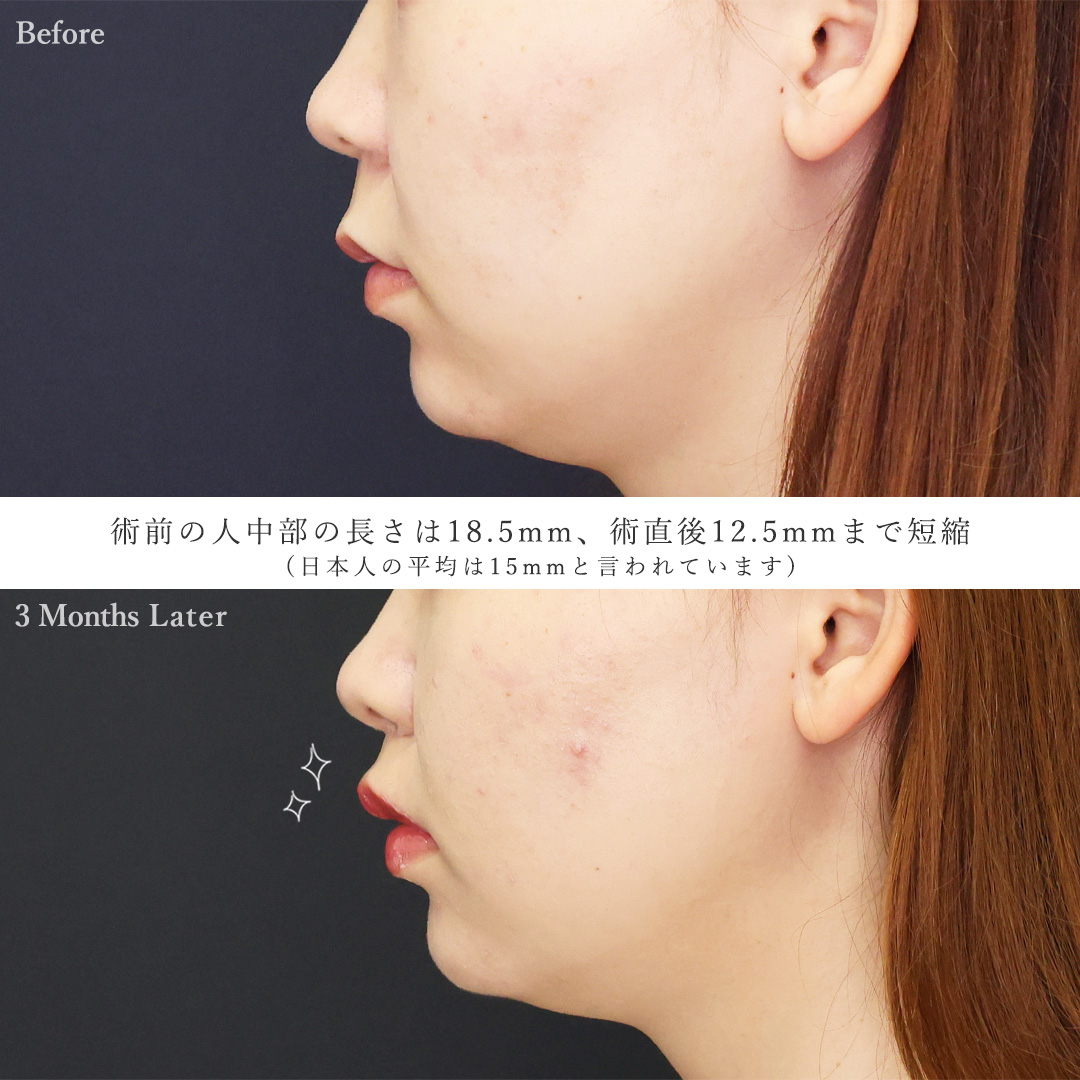 人中短縮術(リップリフト)・外側人中短縮術の症例写真 施術前後 