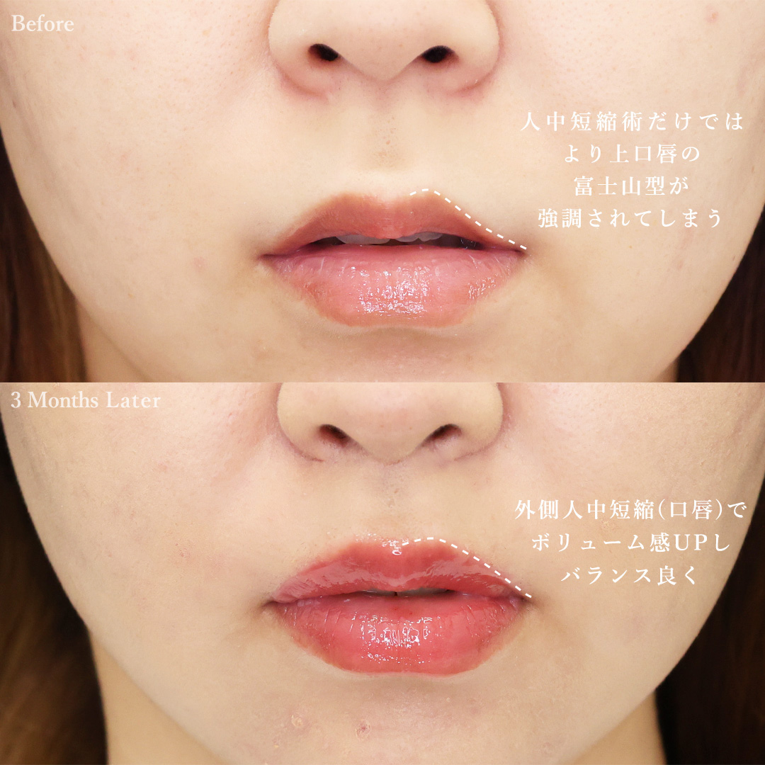 人中短縮術(リップリフト)・外側人中短縮術の症例写真 施術前後 