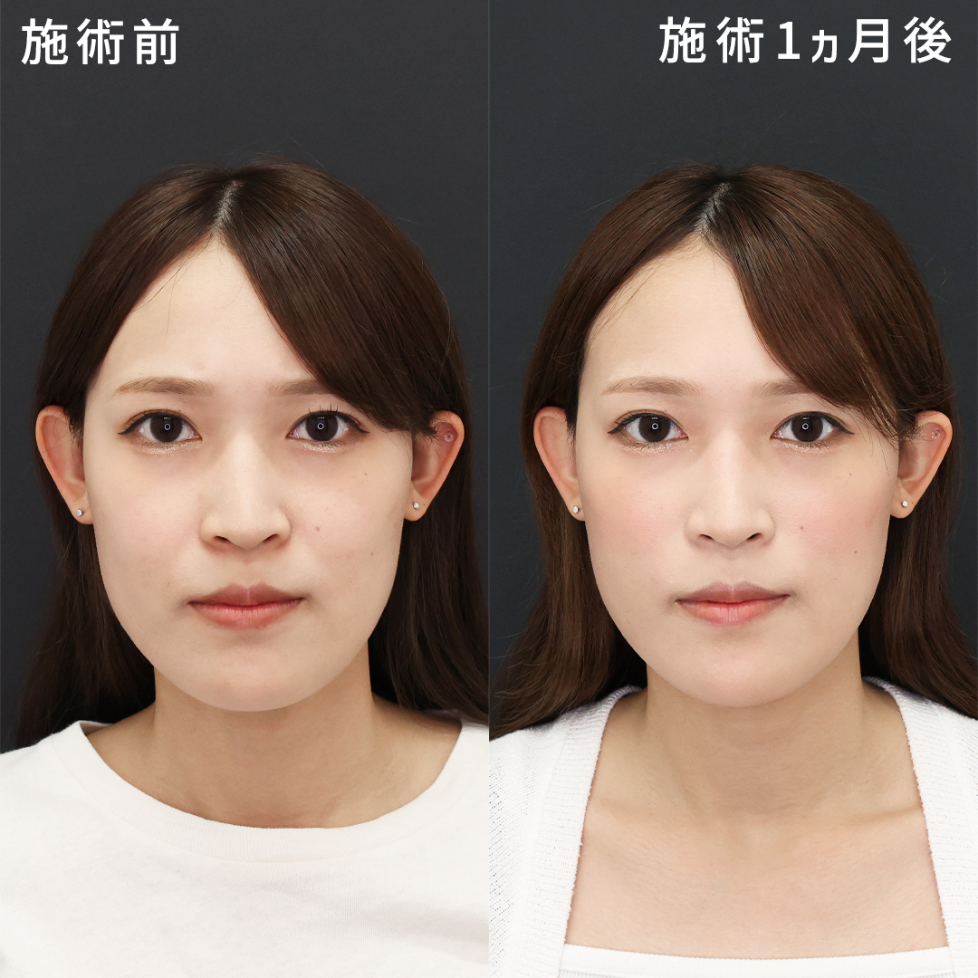 【形成外科専門医執刀】ナゾラビアルファット除去｜脂肪除去でほうれい線を改善