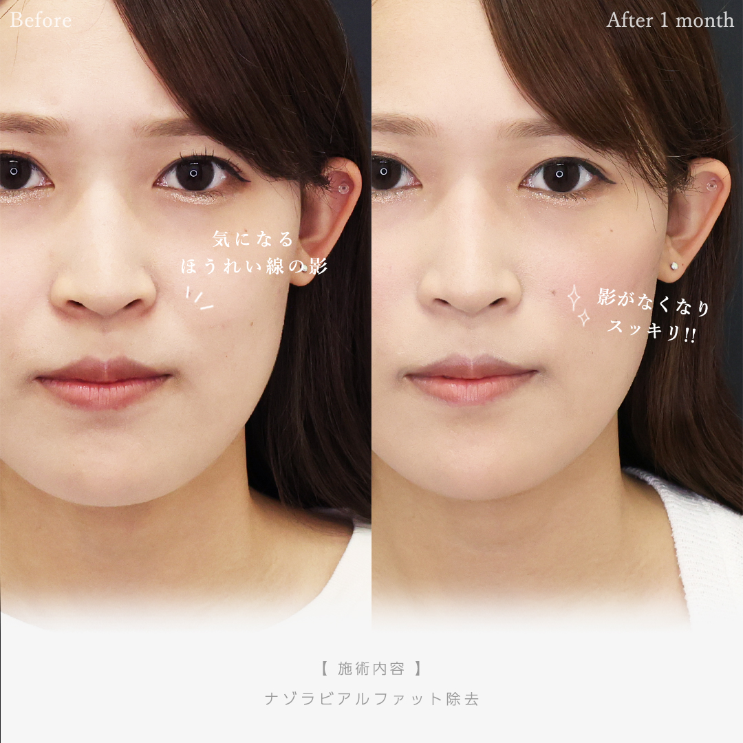 ナゾラビアルファット除去の症例写真 施術前後 