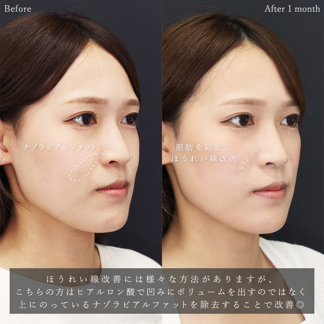 ナゾラビアルファット除去の症例写真 施術前後 