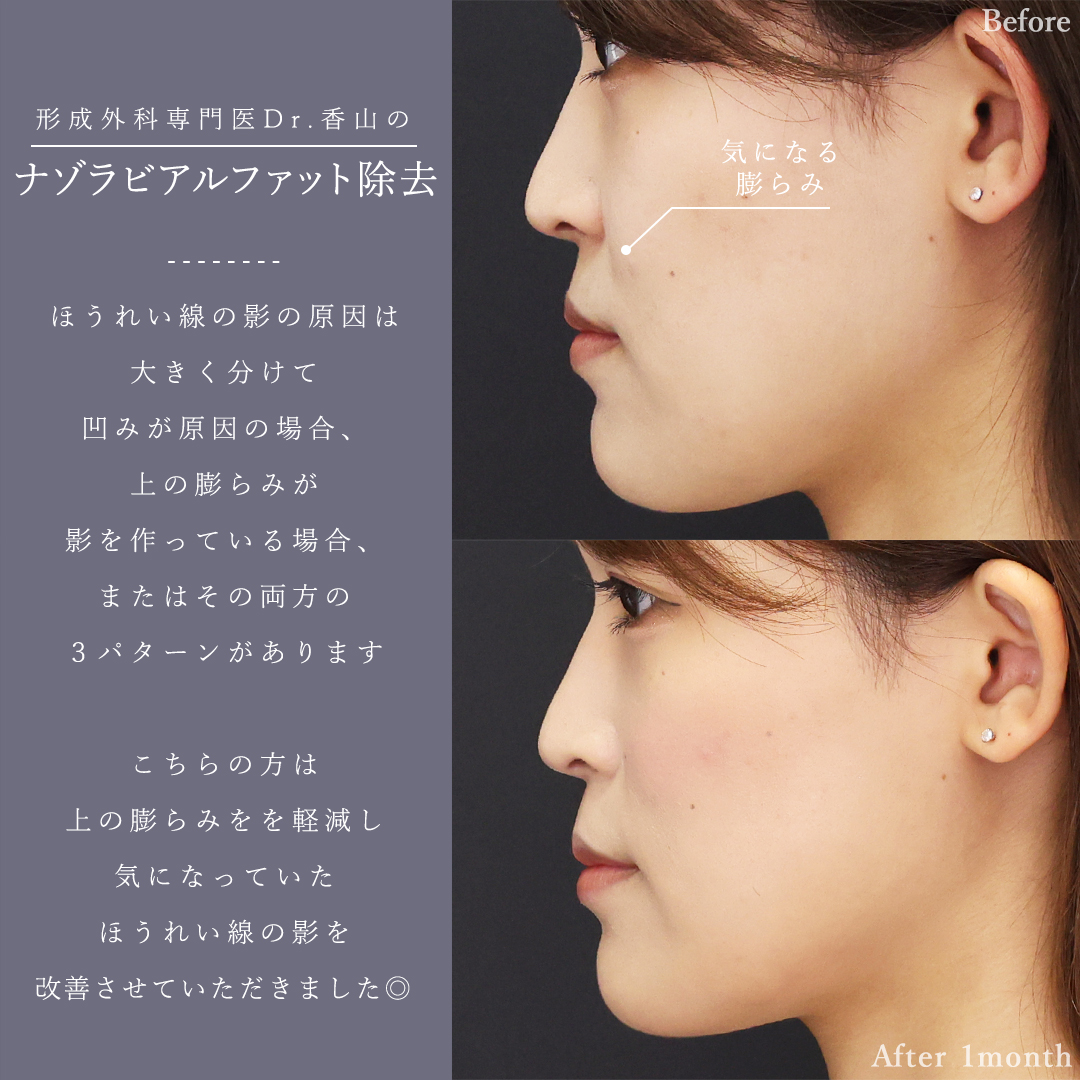 ナゾラビアルファット除去の症例写真 施術前後 