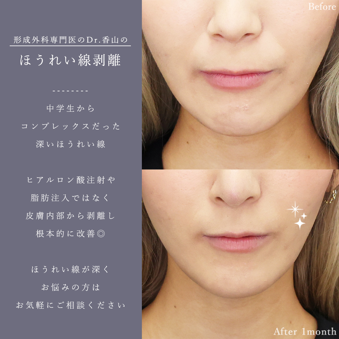 口整形：その他（ほうれい線剥離など）/鼻中隔延長術/鼻尖形成・鼻尖縮小の症例写真 施術前後 