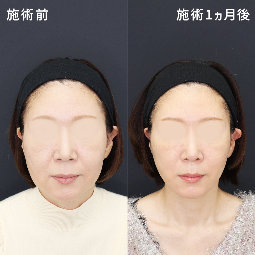 【50代】口元のもたつきを解消し、若々しい印象に◎