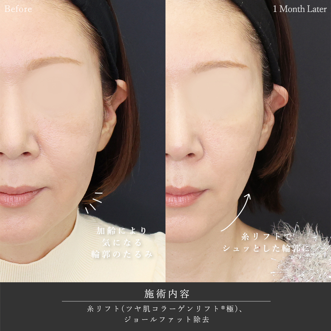 TAC式 ツヤ肌コラーゲンリフト®/ジョールファット除去の症例写真 施術前後