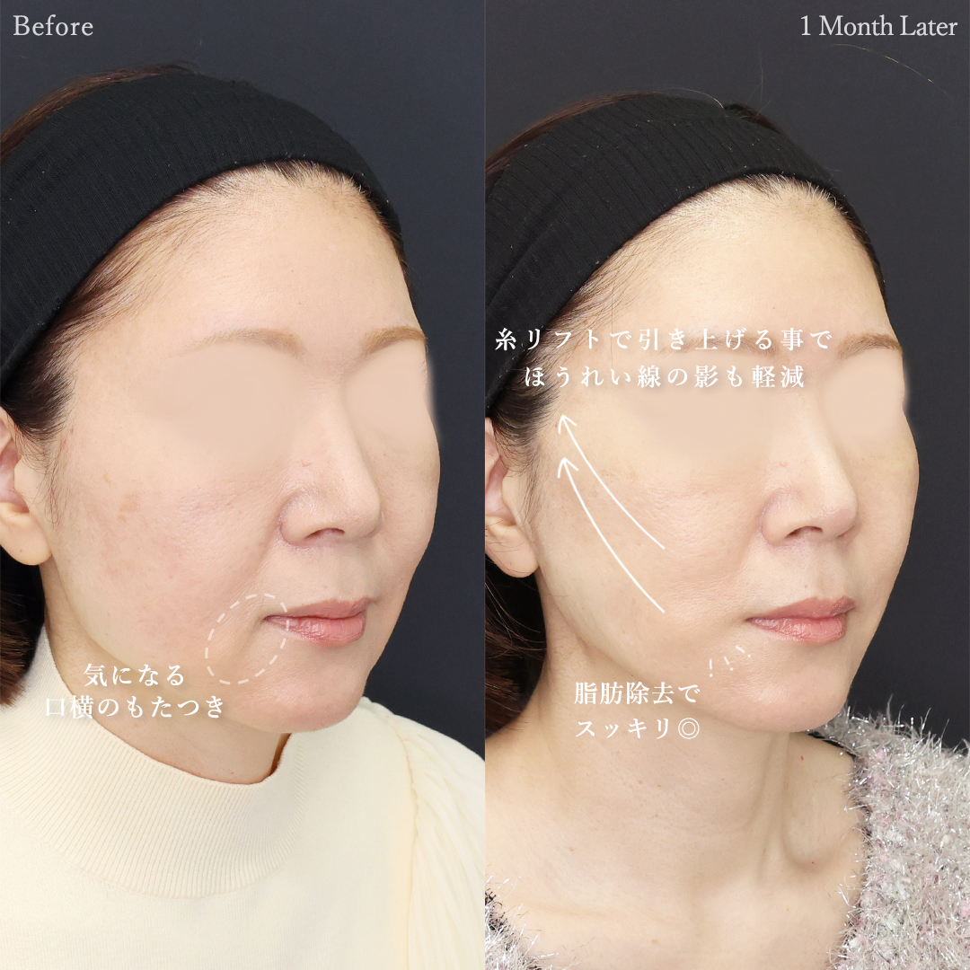 TAC式 ツヤ肌コラーゲンリフト®/ジョールファット除去の症例写真 施術前後