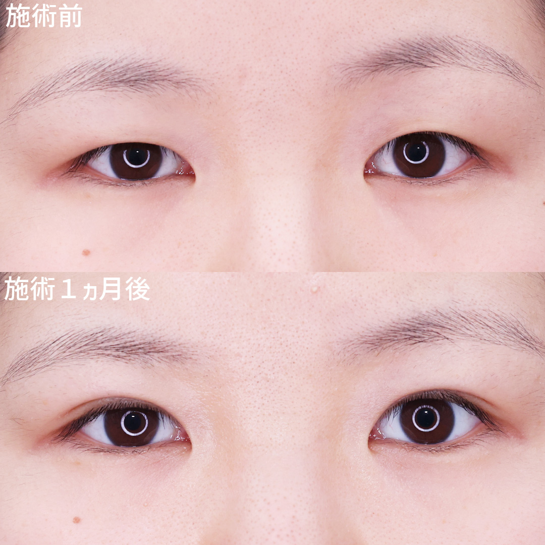 開きの悪さ、左右差も整い、自信の持てる目元に！