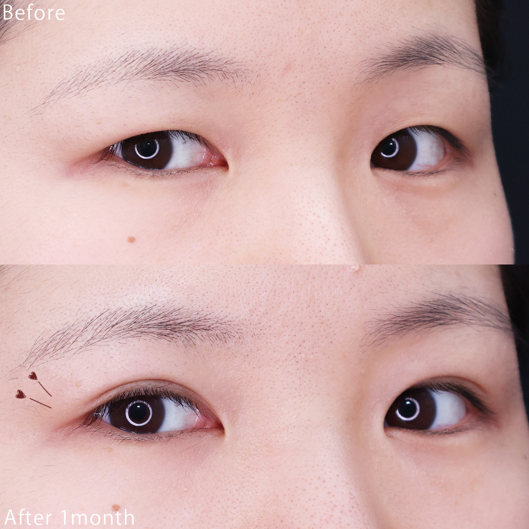 二重埋没法の症例写真 施術前後 