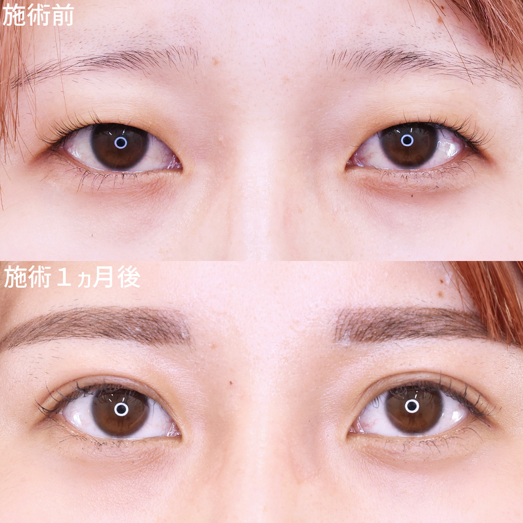 重ため一重さんも【埋没法】で華やかなお目元に！