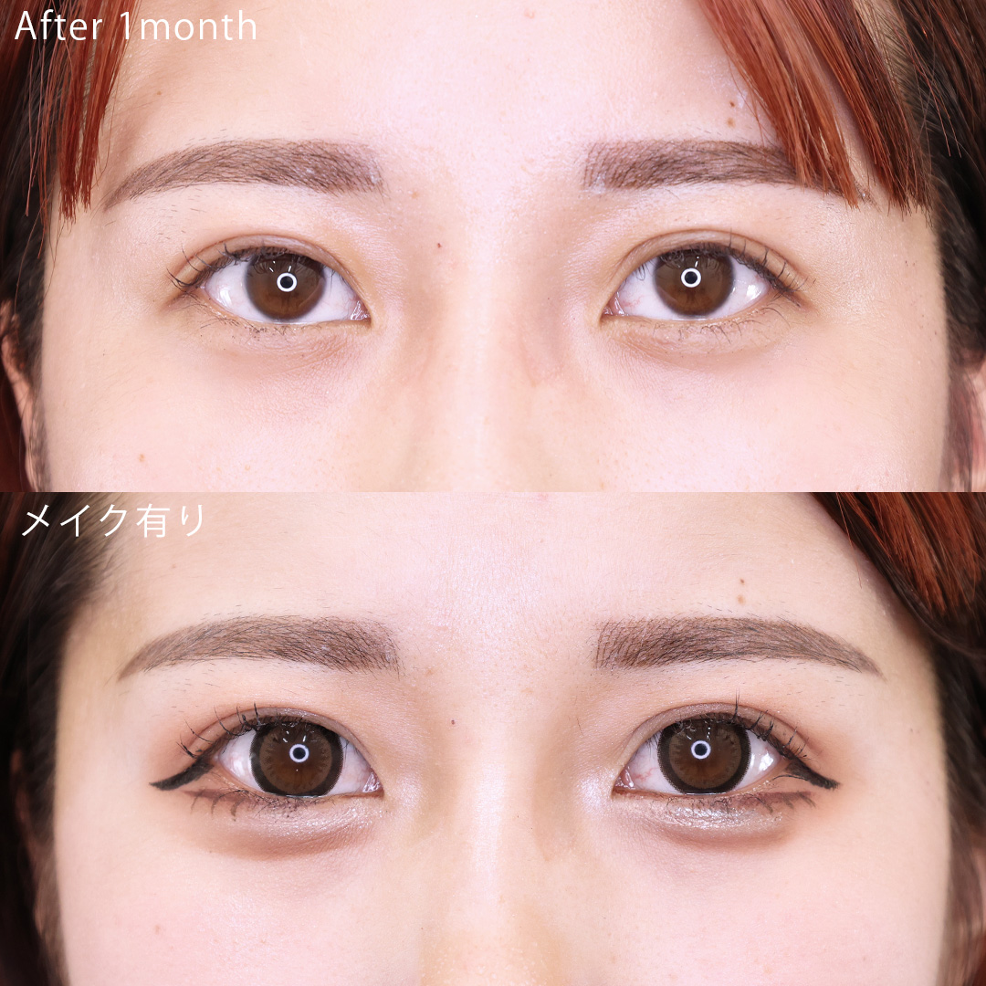 二重埋没法の症例写真 施術前後 