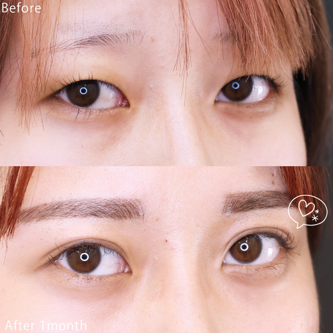 二重埋没法の症例写真 施術前後 