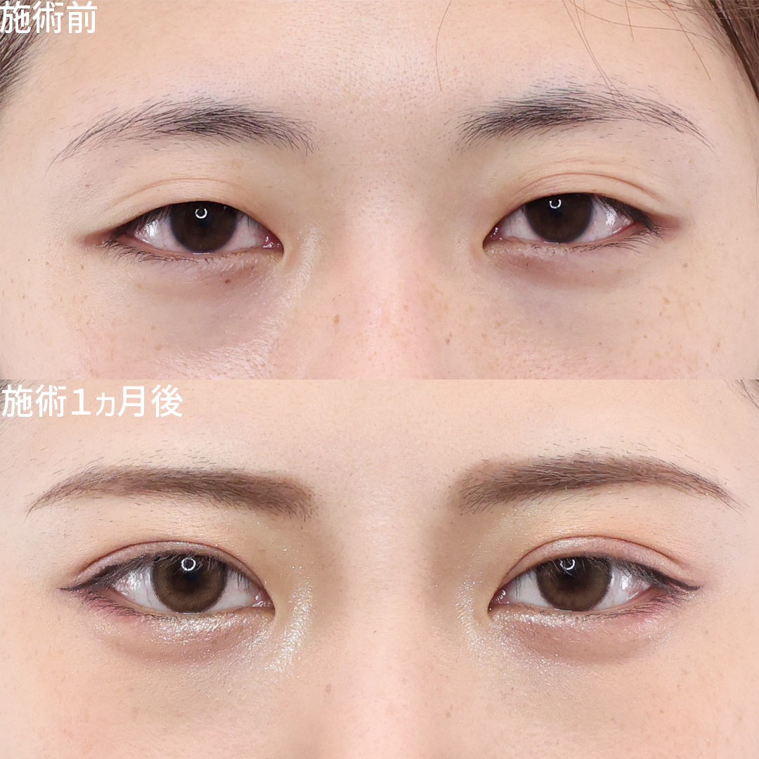 愛され目元に大変身♥二重埋没法で憧れの平行二重に【Dr.森】