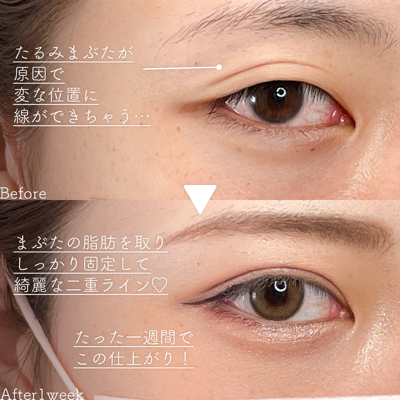 二重埋没法の症例写真 施術前後 