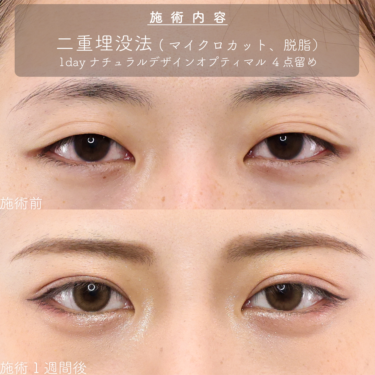 二重埋没法の症例写真 施術前後 