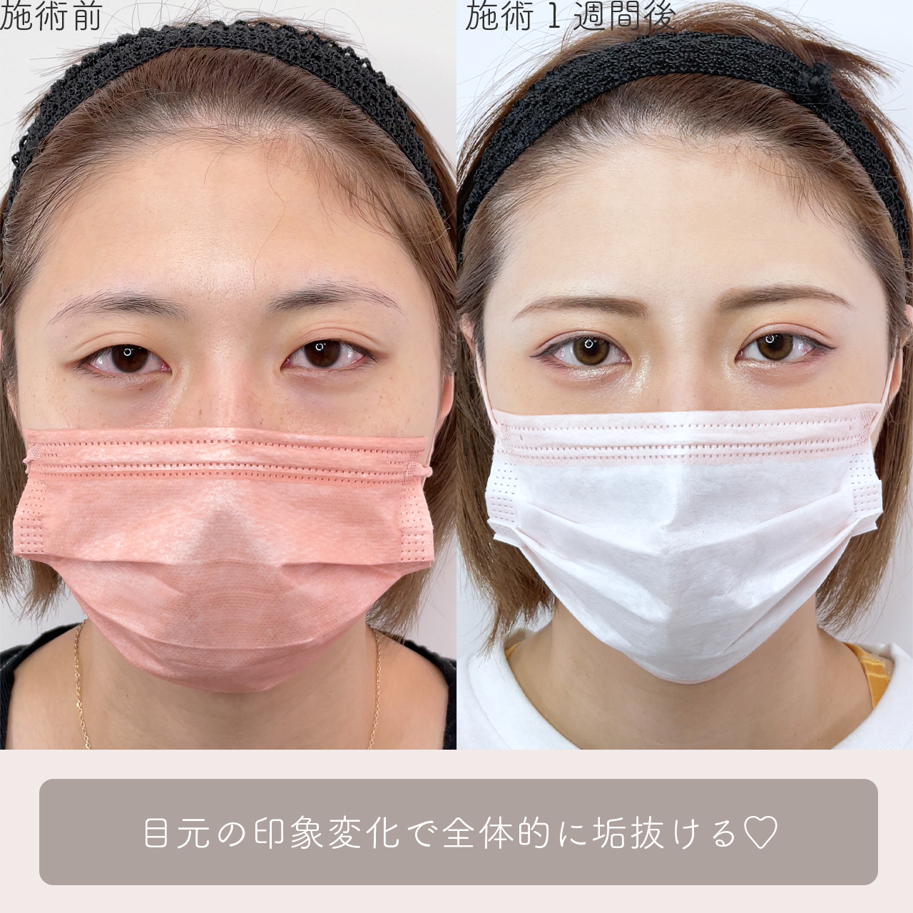 二重埋没法の症例写真 施術前後 