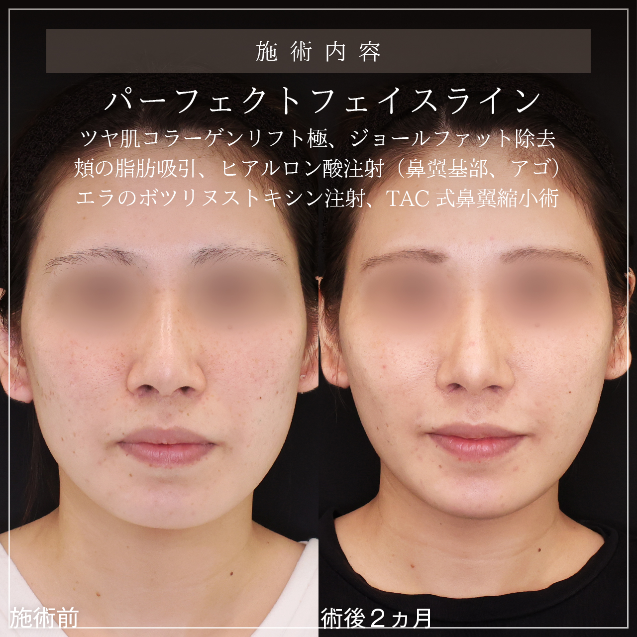 小顔整形｜パーフェクトフェイスライン/エラボトックス注射/顔の脂肪吸引の症例写真 施術前後 