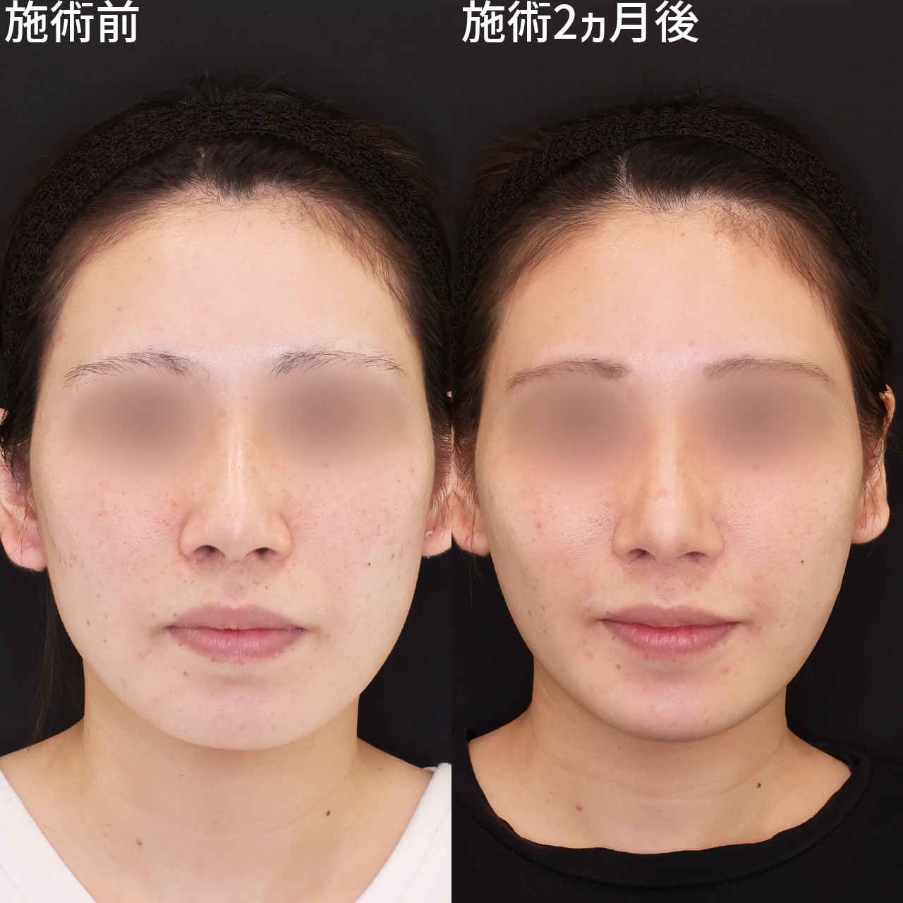 《Dr.森の小顔術》輪郭を一回り小さくして自然な顔痩せ