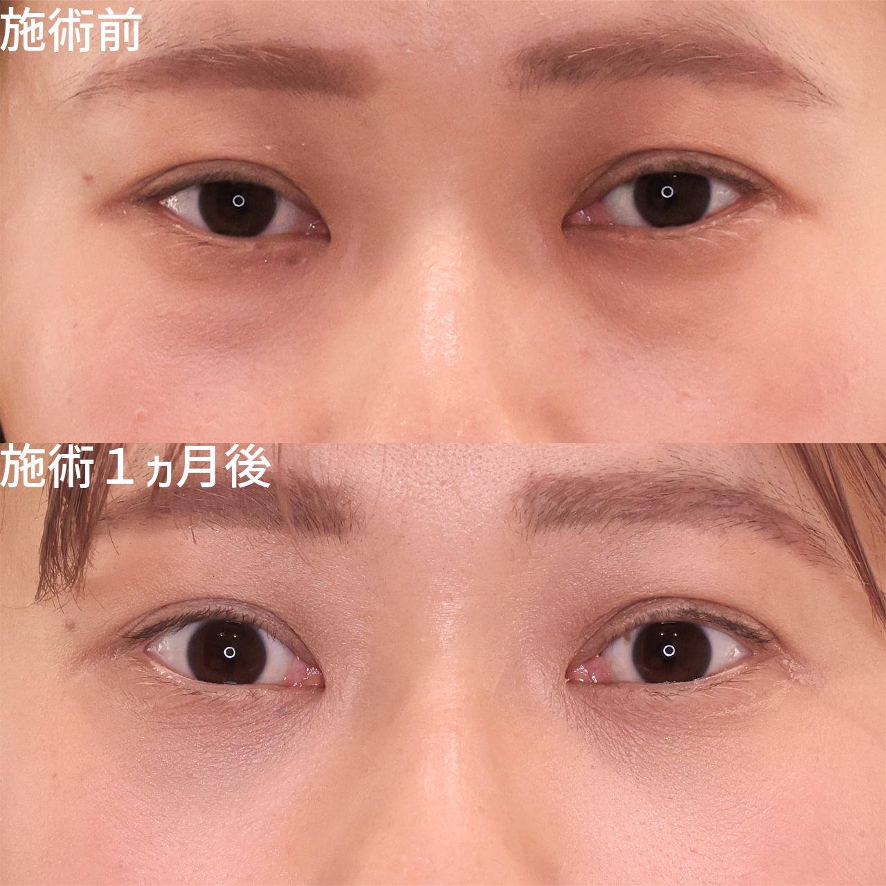 下眼瞼脱脂術(目の下のたるみ取り・目の下の脂肪ふくらみ取り)の症例写真 施術前後