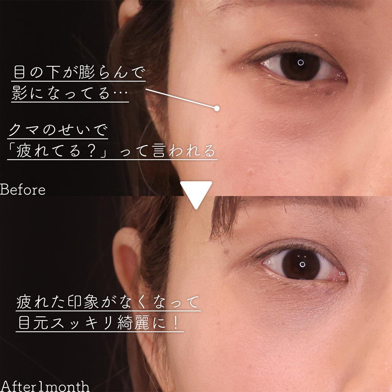 下眼瞼脱脂術(目の下のたるみ取り・目の下の脂肪ふくらみ取り)の症例写真 施術前後