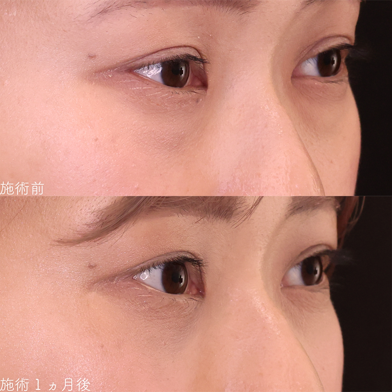 下眼瞼脱脂術(目の下のたるみ取り・目の下の脂肪ふくらみ取り)の症例写真 施術前後
