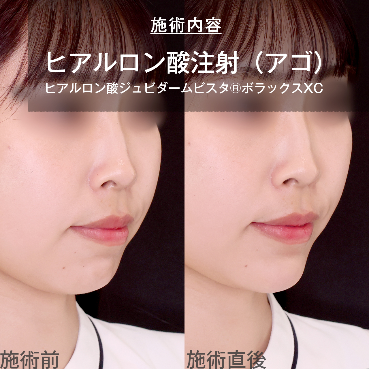 顎のヒアルロン酸注射の症例写真 施術前後
