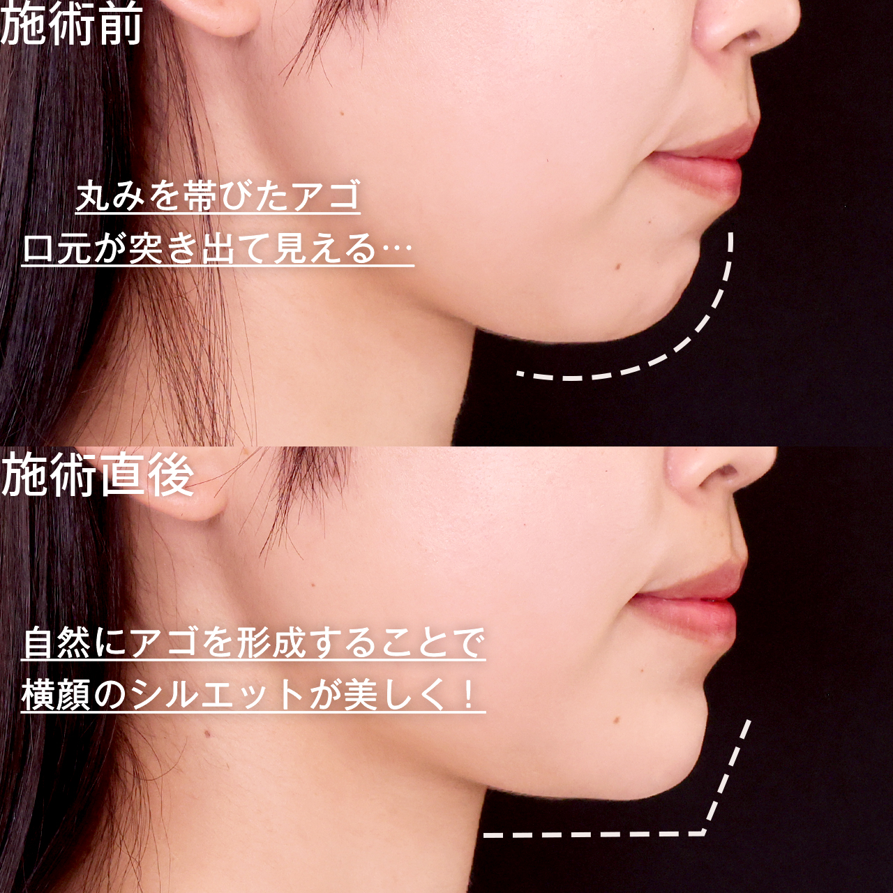 顎のヒアルロン酸注射の症例写真 施術前後