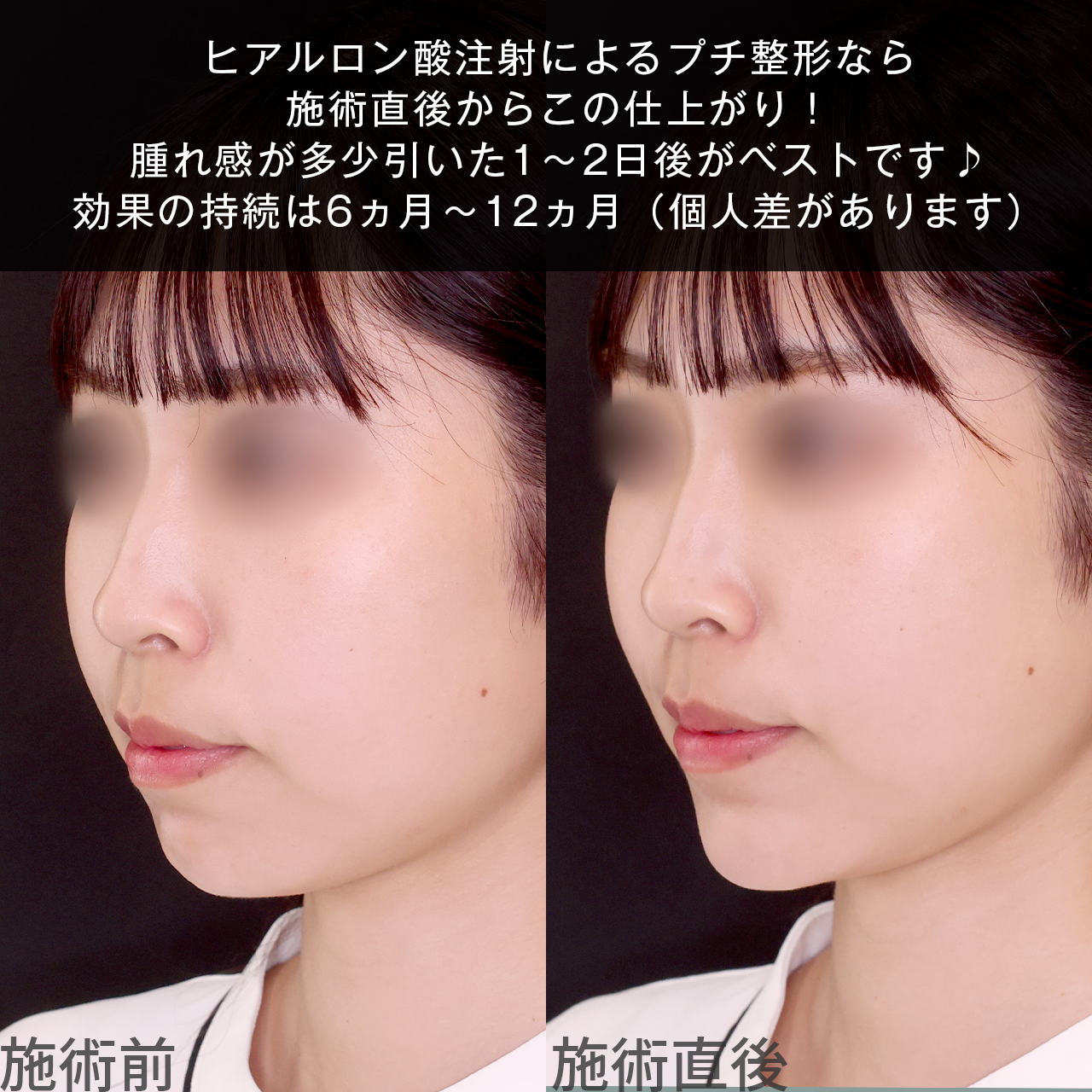 顎のヒアルロン酸注射の症例写真 施術前後