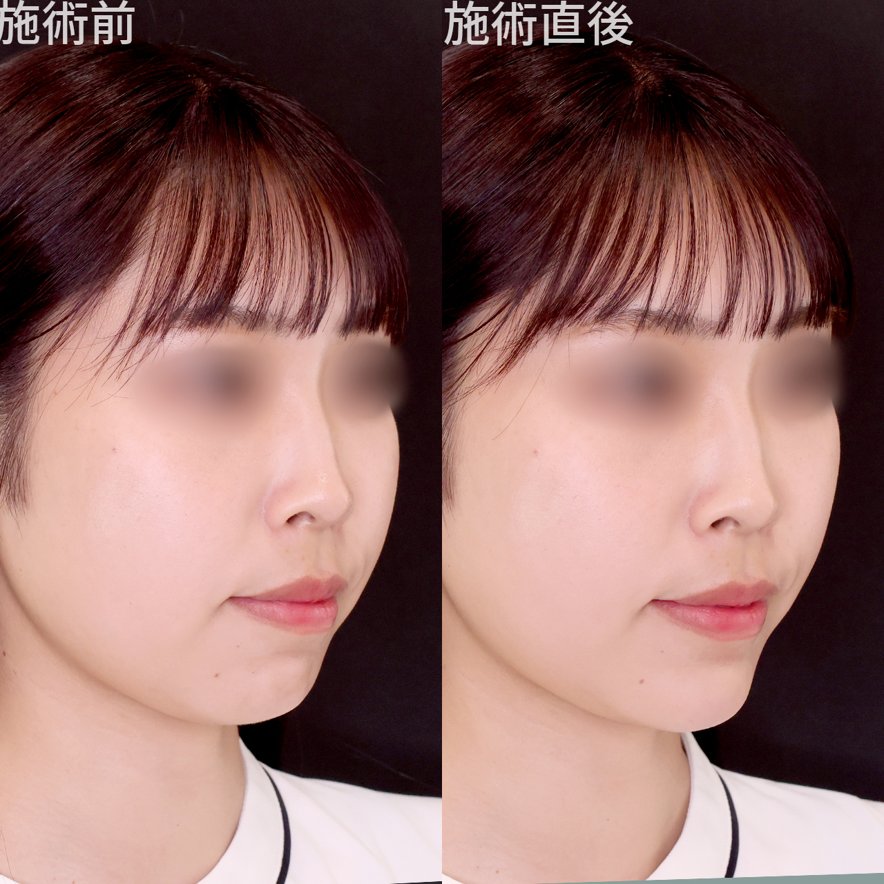 《ヒアル注射》施術時間はたったの１０分！手軽に口ゴボ改善《プチ整形》