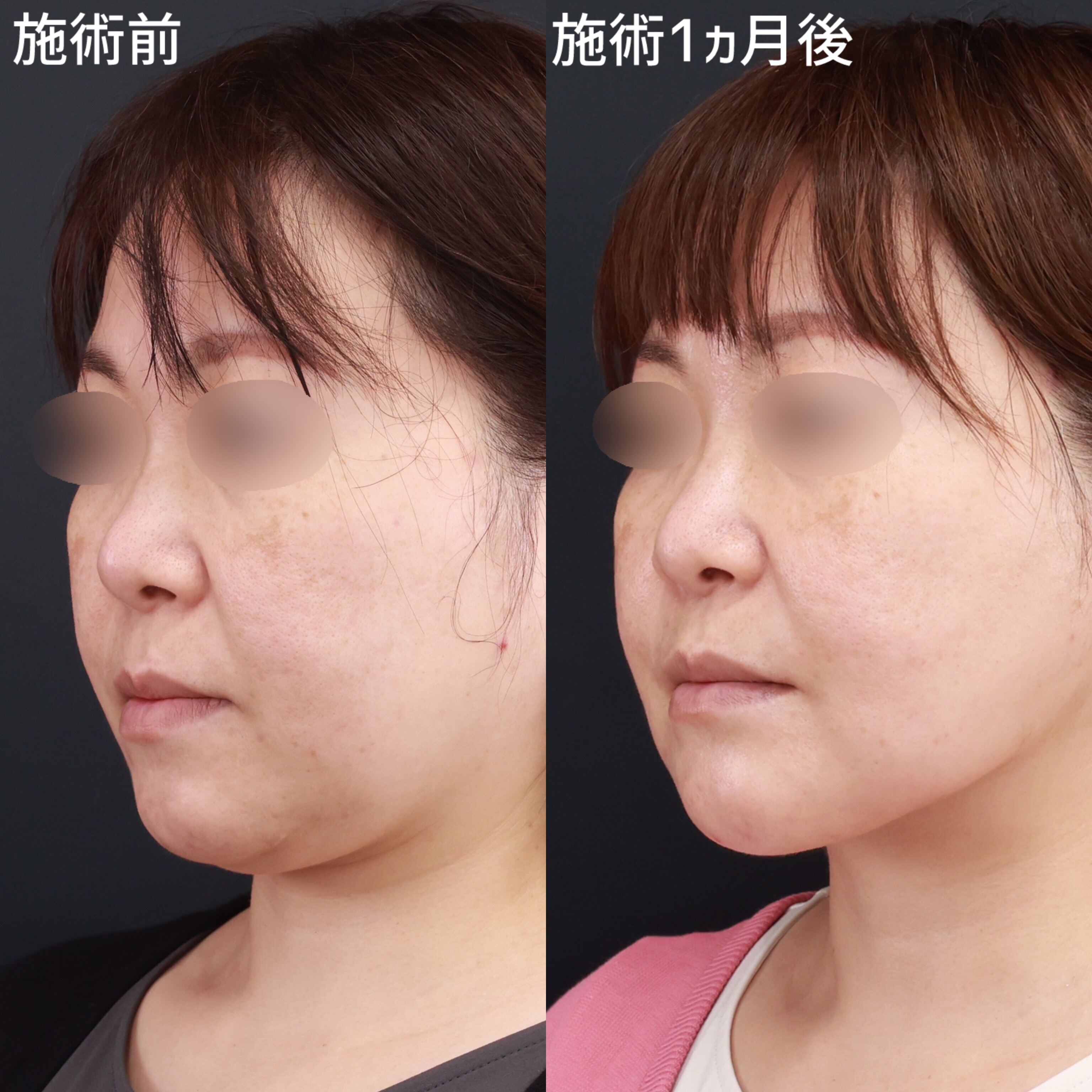 【小顔整形】アゴ下の脂肪を撃退！理想のフェイスラインへ！