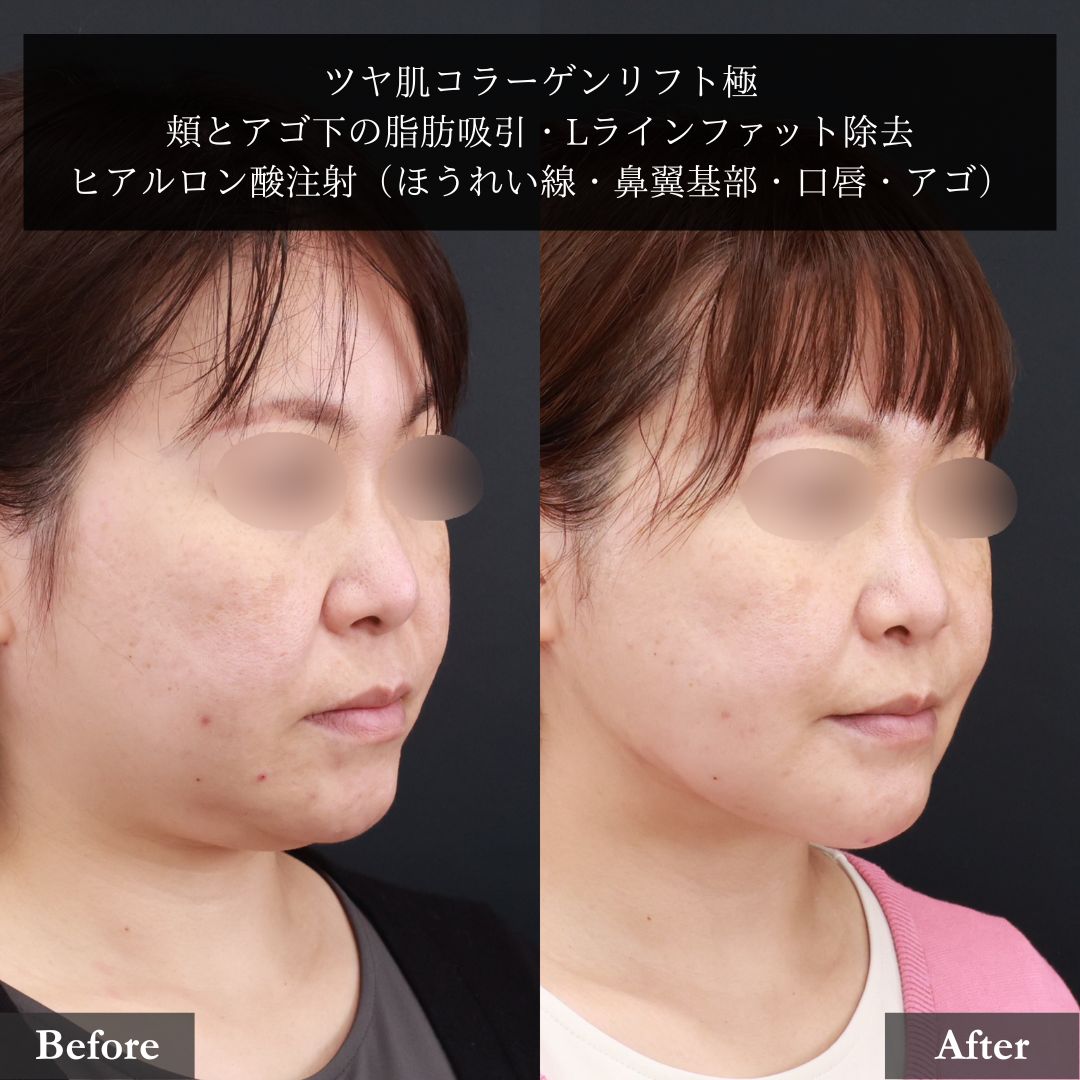 TAC式 ツヤ肌コラーゲンリフト®/小顔整形｜パーフェクトフェイスライン/顎下の脂肪吸引の症例写真 施術前後 