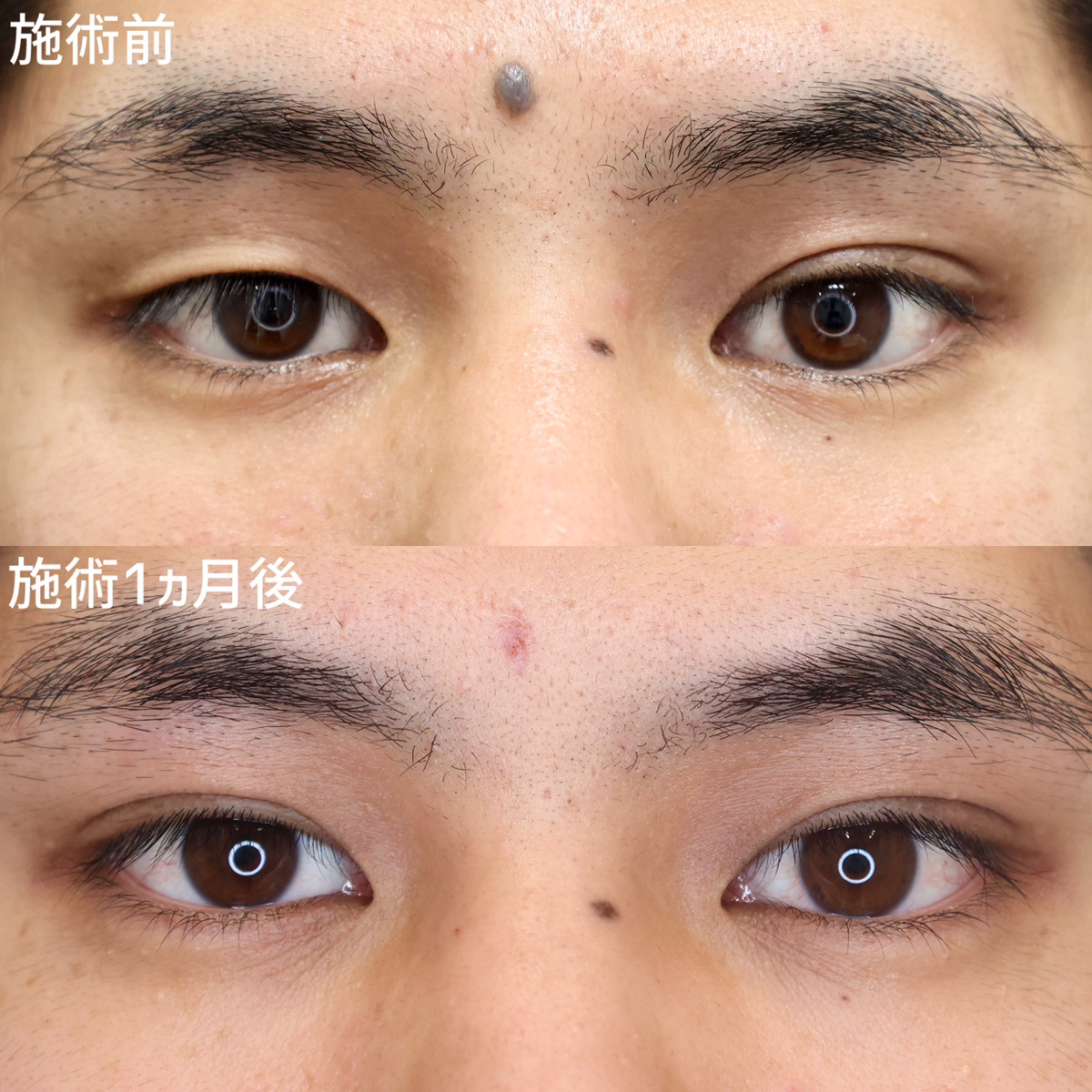 二重埋没法/目元：その他の症例写真 施術前後 