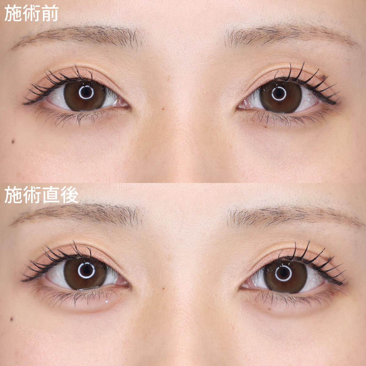 【涙袋のヒアルロン酸注射】でぷっくり可愛い目元！