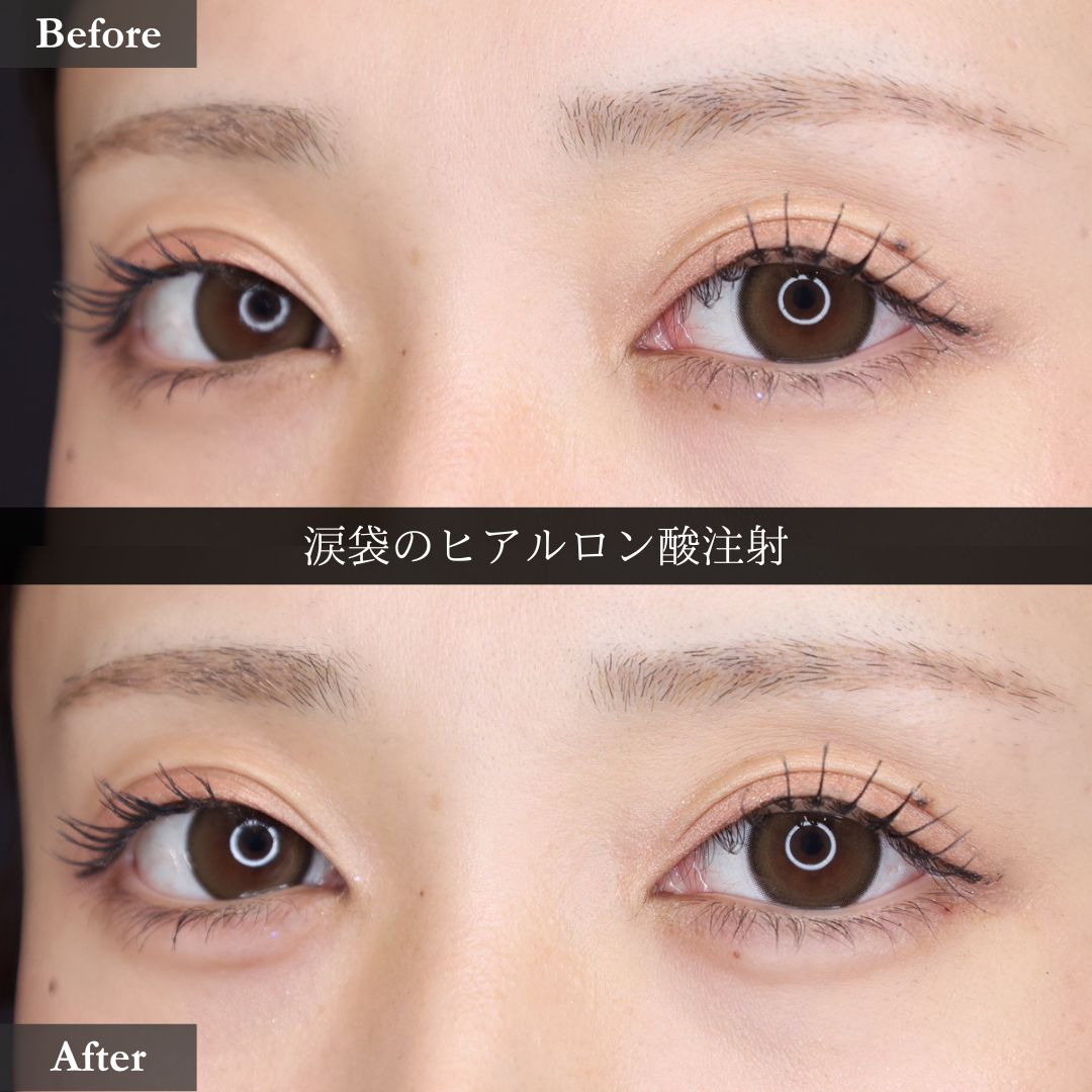 涙袋形成（ヒアルロン酸注射）の症例写真 施術前後 