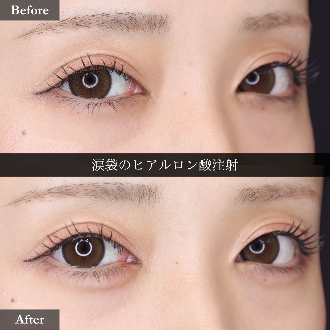 涙袋形成（ヒアルロン酸注射）の症例写真 施術前後 