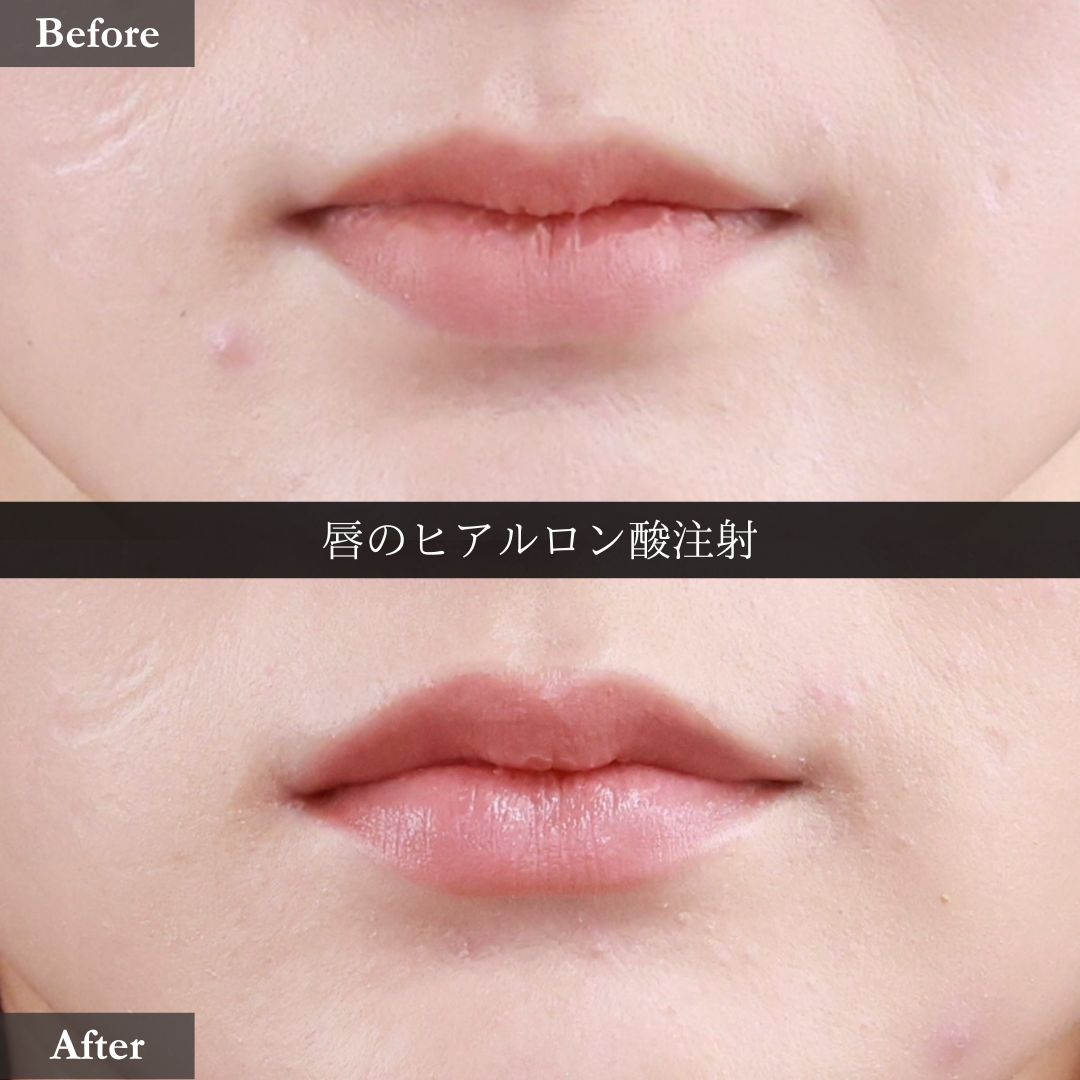 ヒアルロン酸注射:その他の症例写真 施術前後