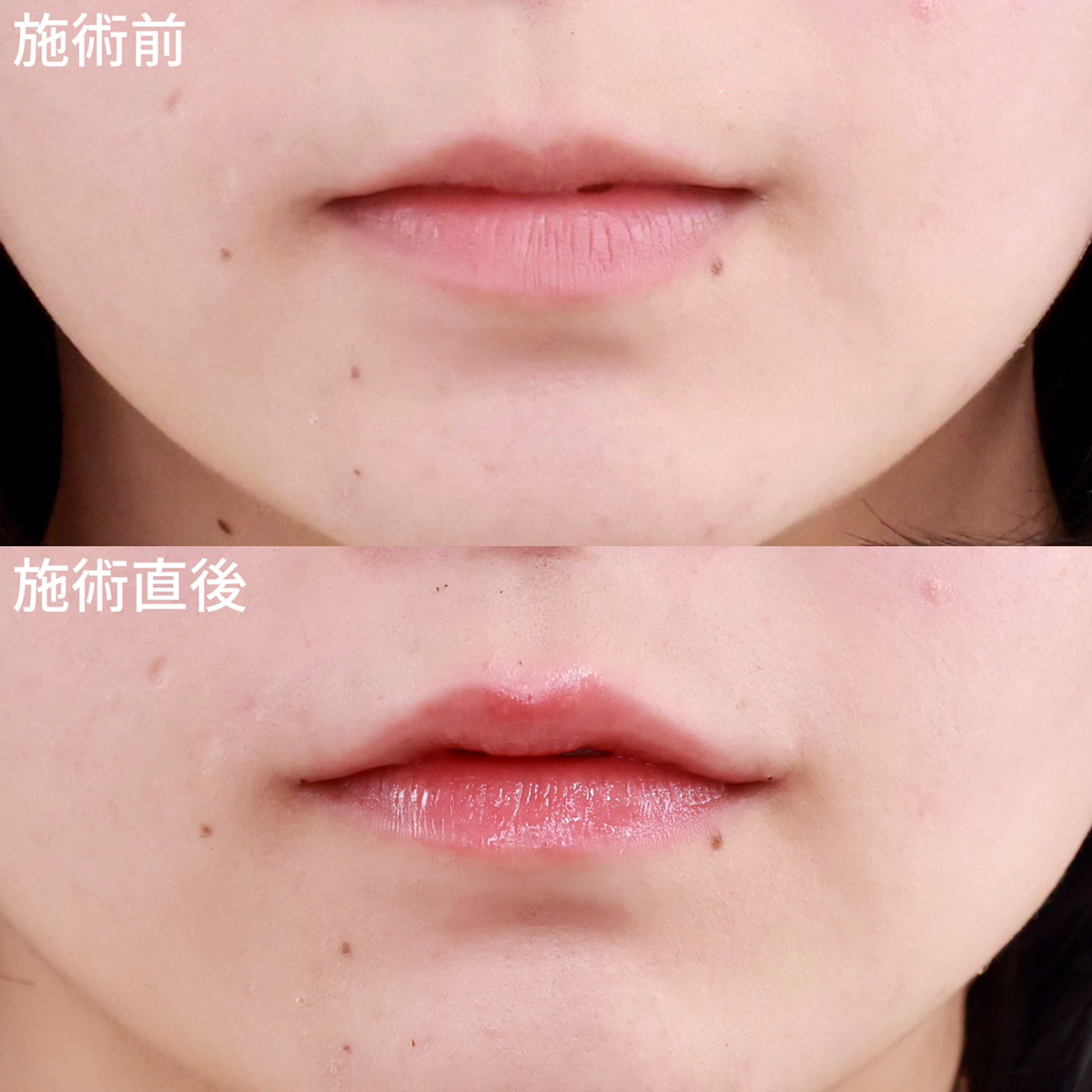 【ヒアルロン酸注射】M字リップで女性らしさUP