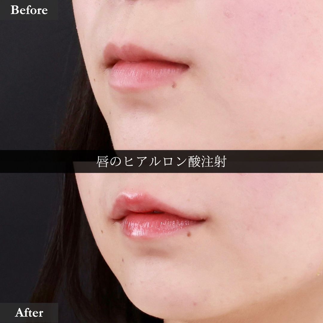 ヒアルロン酸注射：その他の症例写真 施術前後 