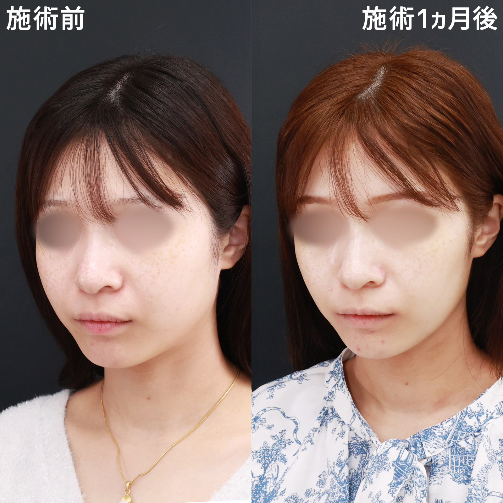 顔の脂肪吸引/Lラインファット除去(エラ下脂肪除去)の症例写真 施術前後