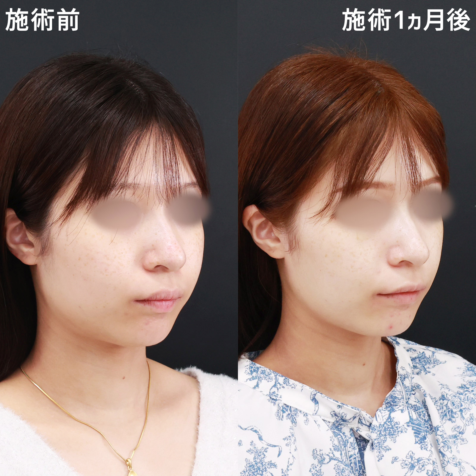 顔の脂肪吸引/Lラインファット除去(エラ下脂肪除去)の症例写真 施術前後