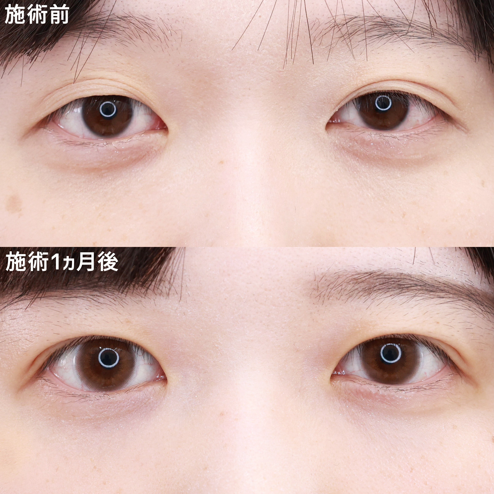 【バレにくい二重埋没法】たるみ瞼をスッキリとした末広二重に！