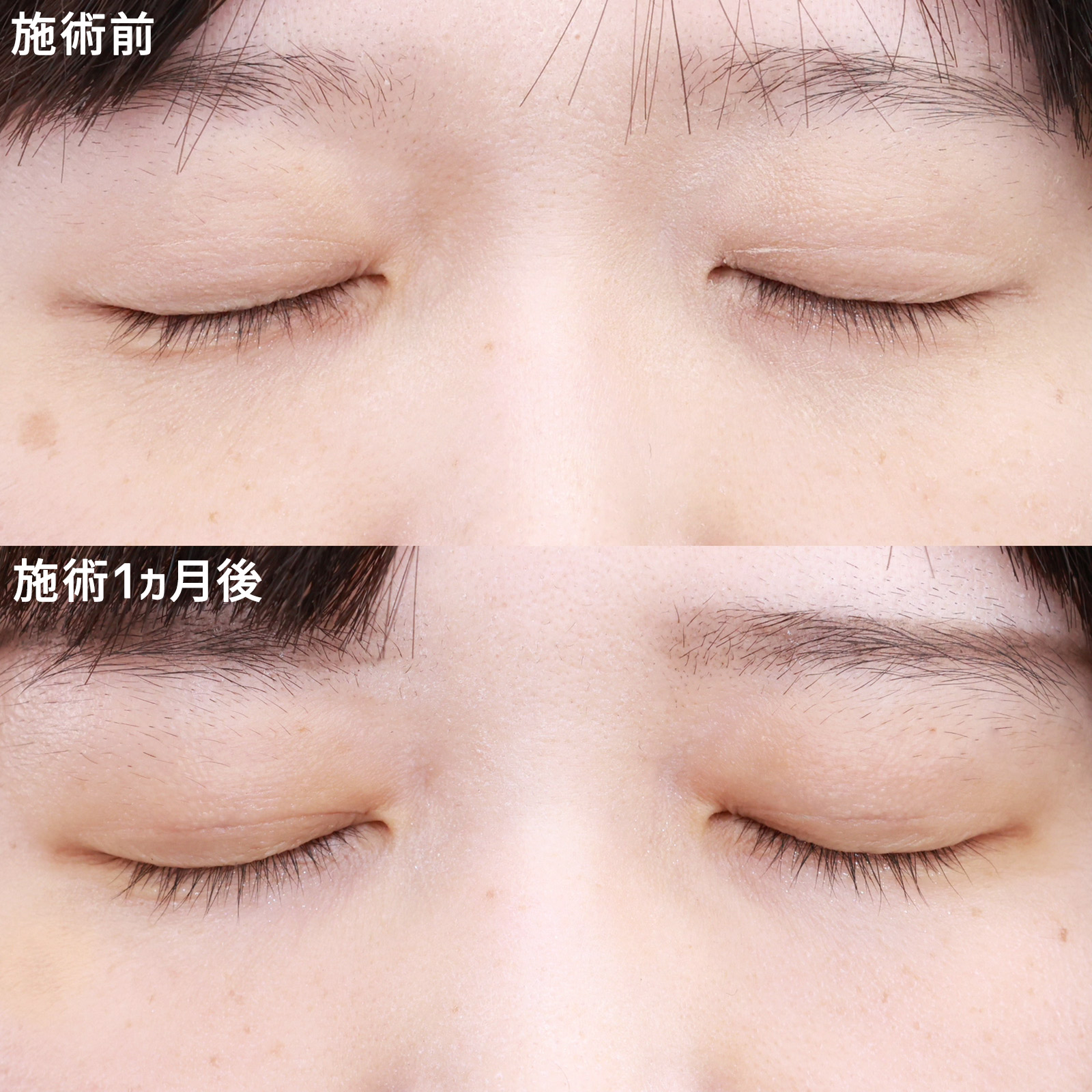 クイックコスメリングの症例写真 施術前後 