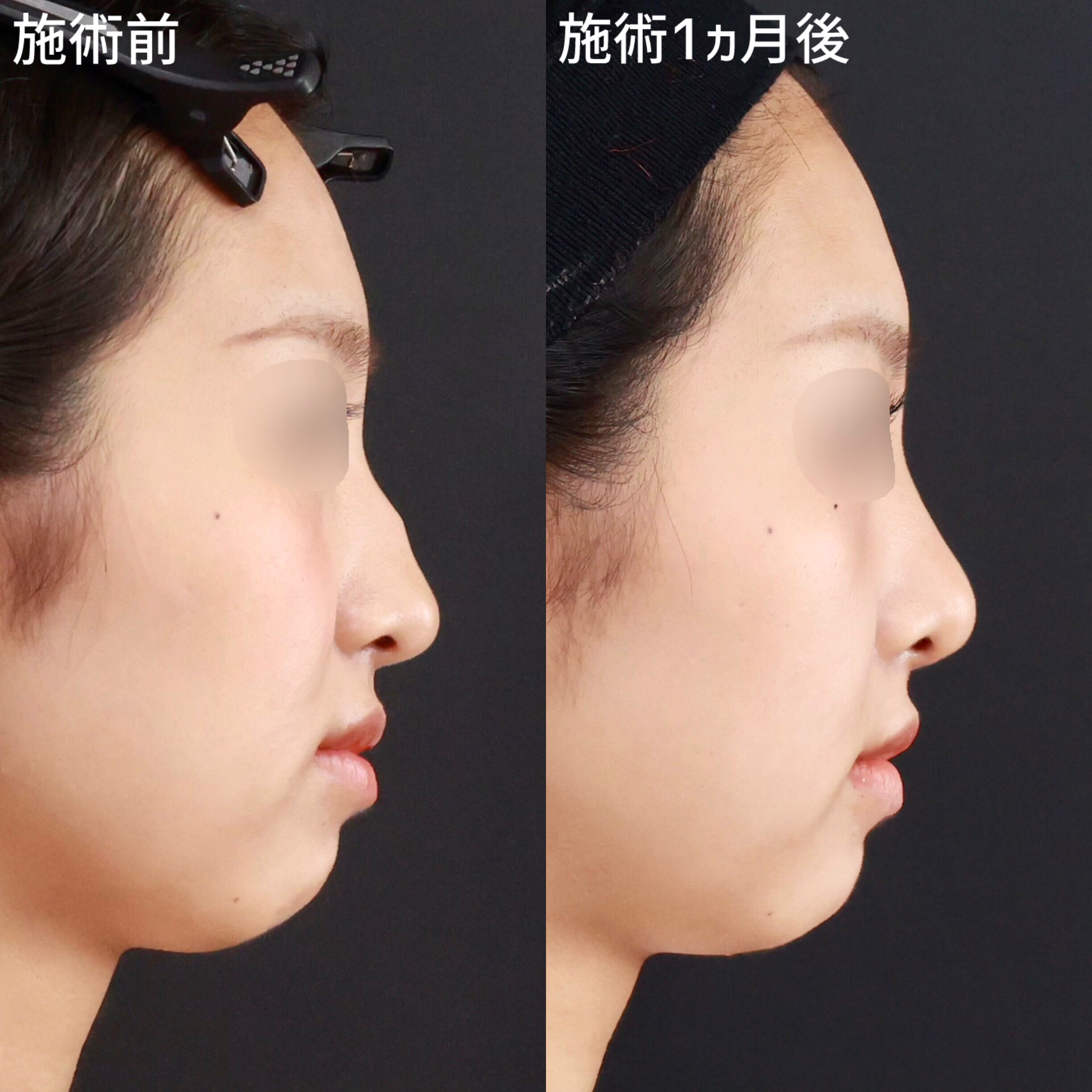 【鼻整形】ゴツゴツとした鼻筋が女性らしい印象へ