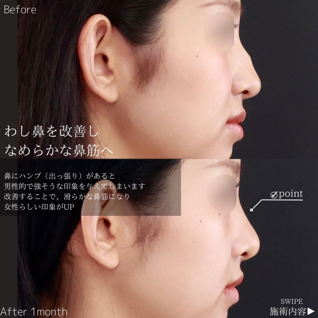 鼻：その他の症例写真 施術前後 